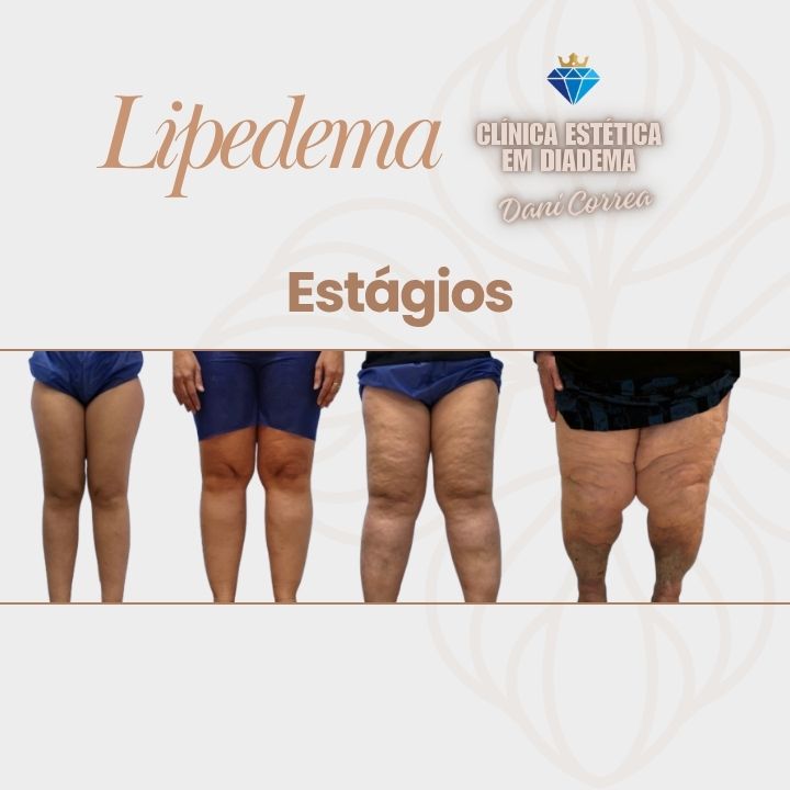 lipedema5